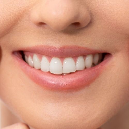 Teeth whitening Larnaca