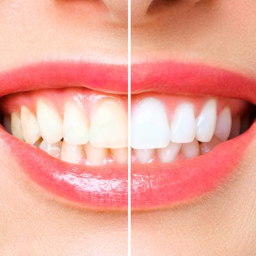 Teeth Whitening Procedure in Larnaca Cyprus